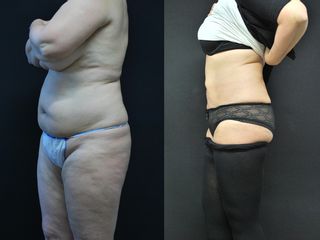 Bioliponemesi prima e dopo