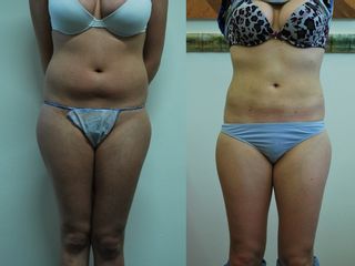 Bioliponemesi prima e dopo