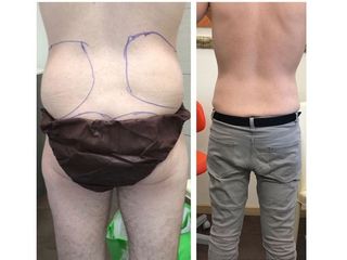 Liposuzione prima e dopo