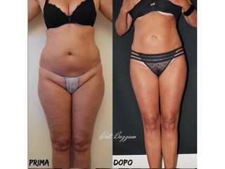 Liposuzione prima e dopo