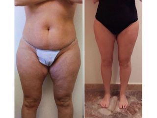 Liposuzione prima e dopo