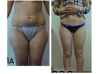 Liposuzione prima e dopo