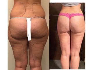 Liposuzione prima e dopo