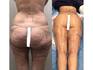 Liposuzione prima e dopo