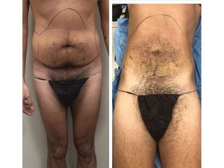Liposuzione prima e dopo