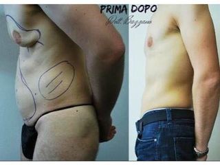 Ginecomastia prima e dopo