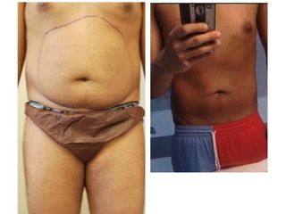 Liposuzione prima e dopo
