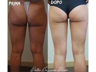 Liposuzione prima e dopo