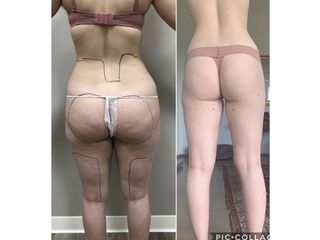 Liposcultura - Dottor Bazzano Dario