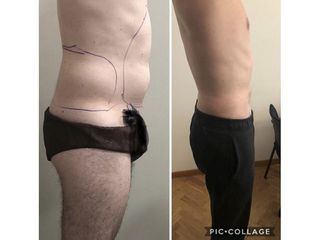 Liposcultura - Dottor Bazzano Dario