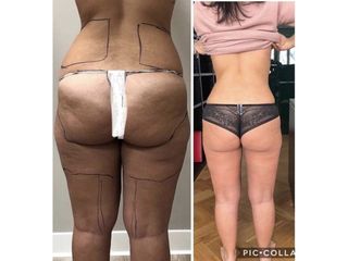 Liposcultura - Dottor Bazzano Dario