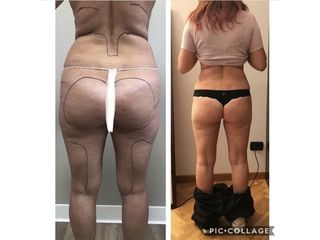Liposcultura - Dottor Bazzano Dario