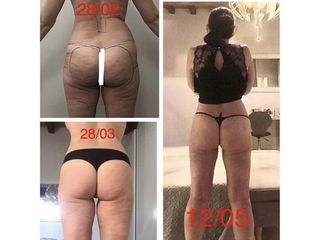 Liposcultura - Dottor Bazzano Dario