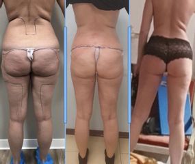 Liposuzione - Dott. Dario Bazzano