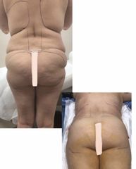 Liposuzione - Dott. Dario Bazzano
