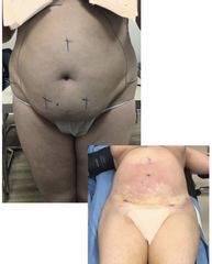 Liposuzione - Dott. Dario Bazzano