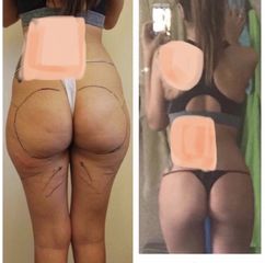 Liposuzione - Dott. Dario Bazzano