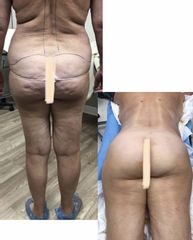 Liposuzione - Dott. Dario Bazzano