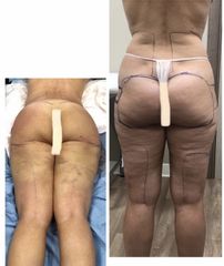 Liposuzione - Dott. Dario Bazzano