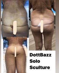 Liposuzione - Dott. Dario Bazzano