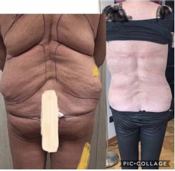 Liposuzione - Dott. Dario Bazzano