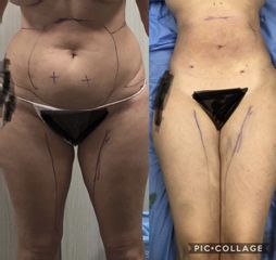Liposuzione - Dott. Dario Bazzano