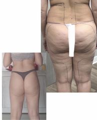 Liposuzione - Dott. Dario Bazzano