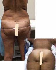 Liposuzione - Dott. Dario Bazzano