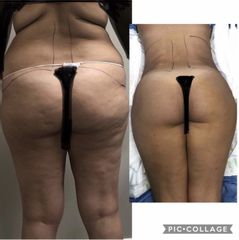 Liposuzione - Dott. Dario Bazzano