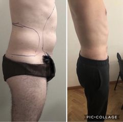 Liposuzione - Dott. Dario Bazzano