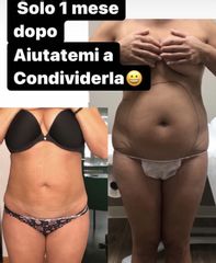 Liposuzione - Dott. Dario Bazzano