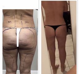 Liposuzione - Dott. Dario Bazzano