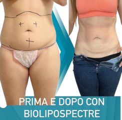 Liposcultura - Dott. Dario Bazzano