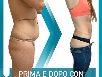 Lipo Vaser - 869613