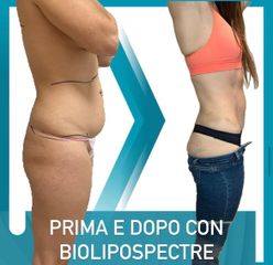 Lipo Vaser - Dott. Dario Bazzano