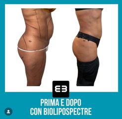 Liposcultura - Dott. Dario Bazzano