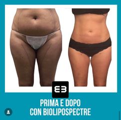 Liposcultura - Dott. Dario Bazzano