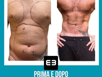 Lipo Vaser - 869619