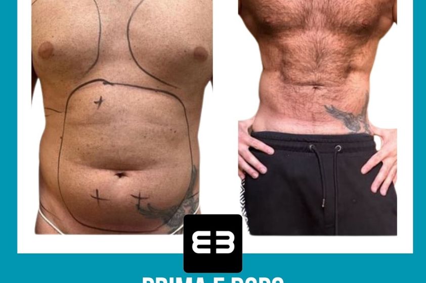 Lipo Vaser prima e dopo - 869619