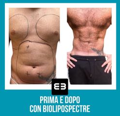 Lipo Vaser - Dott. Dario Bazzano