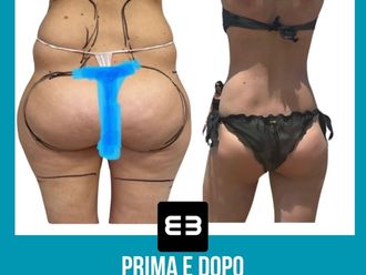 Liposcultura prima e dopo - 869620