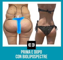 Liposcultura - Dott. Dario Bazzano