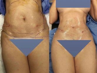 Liposcultura prima e dopo - 869623