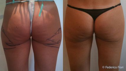 Lipoaspirazione prima e dopo