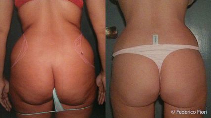 Lipoaspirazione prima e dopo