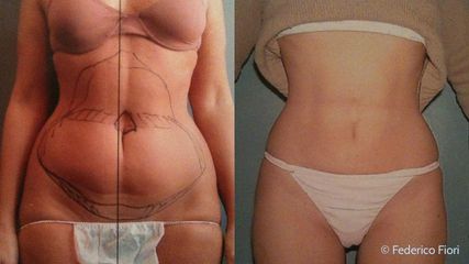 Lipoaspirazione prima e dopo