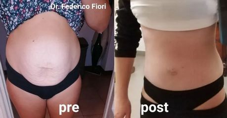 Addominoplastica - Dott. Fiori Federico