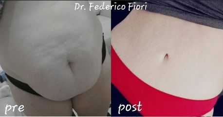 Addominoplastica - Dott. Fiori Federico