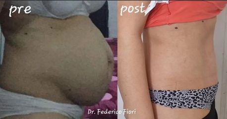 Addominoplastica - Dott. Fiori Federico