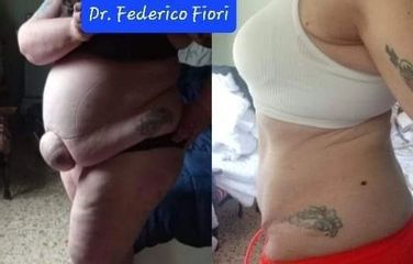 Addominoplastica - Dott. Fiori Federico